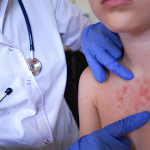 Morbillo negli USA, due morti in Pennsylvania: casi ai massimi da 35 anni